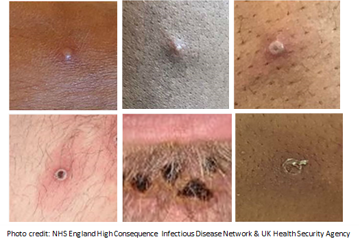 Six images of monkeypox rash in different stages